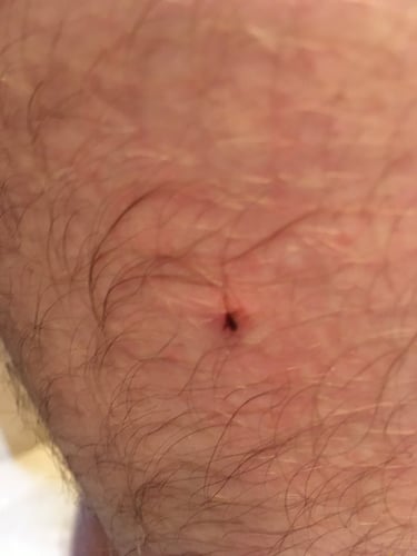 nymph-tick-embedded-in-thigh